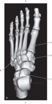 <strong>Questions 57 through 60 refer to the figure below of a 3D CT of the foot. Which arrow is pointing to the base of the fifth metatarsal?</strong> A) A B) B C) C D) D