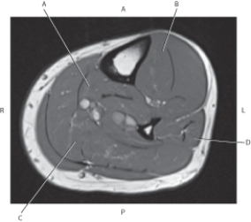 <strong>Questions 61 through 64 refer to the figure below of an axial, T1-weighted MRI of the left tibia. Which arrow is pointing to the flexor digitorum longus muscle?</strong> A) A B) B C) C D) D