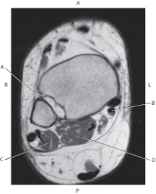 <strong>Questions 65 through 68 refer to the figure below of an axial, T1-weighted MRI of the right ankle. Which arrow is pointing to the flexor digitorum longus tendon?</strong> A) A B) B C) C D) D