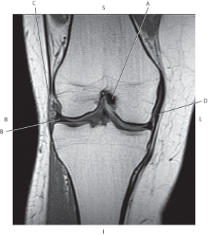 <strong>Questions 69 through 72 refer to the figure below of a coronal, T1-weighted MRI of the right knee. Which arrow is pointing to the posterior cruciate ligament?</strong> A) A B) B C) C D) D
