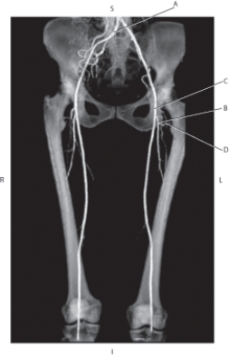 <strong>Questions 73 through 76 refer to the figure below. Which arrow is pointing to the profunda femoris artery?</strong> A) A B) B C) C D) D