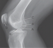 <strong>Which of the labeled structures is the adductor tubercle? </strong> A)A B)B C)C D)D E)E