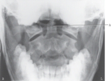<strong>The structure labeled A, which should be well demonstrated on this projection, is the: </strong> A)pedicle. B)lamina. C)odontoid process. D)inferior articular process.