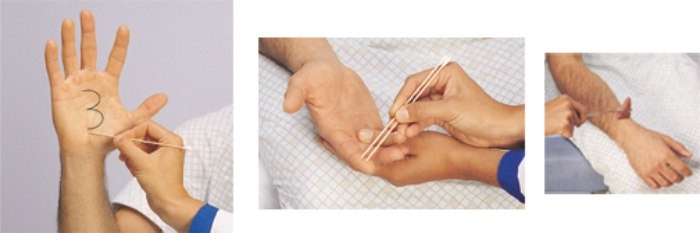 The nurse is conducting a neurological assessment of a patient. Place an X on the technique the nurse should use to test for graphesthesia.