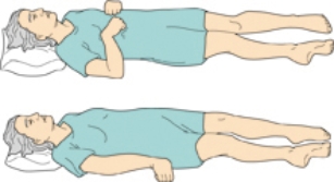 The nurse is caring for a patient with lesions in the corticospinal tracts. Place an X on the position that the nurse should expect to assess in this patient?