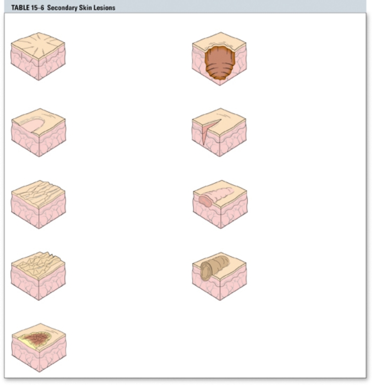 The nurse is caring for a patient with a skin fissure. Place an X over the diagram that represents a skin fissure.