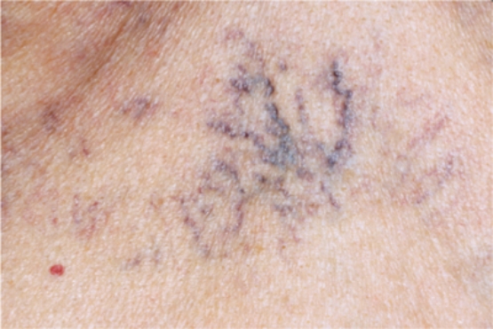 <strong>The nurse notes the presence of this lesion on the patient's anterior chest. How should the nurse document this finding in the medical record? </strong> A) purpura B) ecchymosis C) venous star D) spider angioma