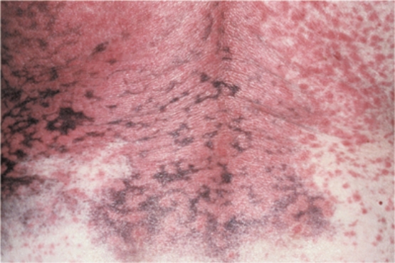 The nurse notes this distribution of lesions on a patient's skin. Based on this finding, the nurse should perform additional assessment looking for indications of which problem?