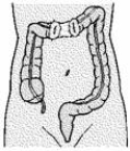 <strong>A patient with a gunshot wound to the abdomen undergoes surgery, and a colostomy is formed as illustrated. The nurse explains to the patient that </strong> A) this type of colostomy is usually temporary. B) soft, formed stool can be expected as drainage. C) the drainage is liquid at this site but less odorous than at higher sites. D) colostomy irrigations can help regulate the drainage from the proximal stoma.