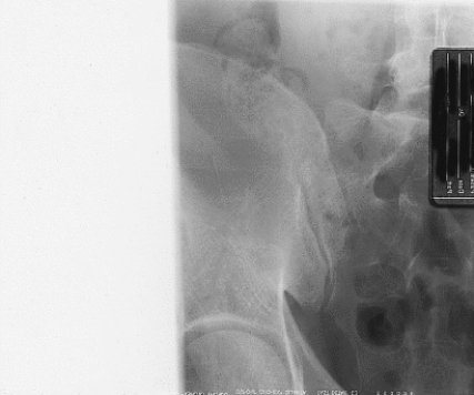 <strong>Which of the following errors is evident in Figure 19-5? </strong> A) There is rotation of the anatomy of interest. B) CR and IR were not aligned. C) The image is too dark. D) There is no error evident in Figure 19-5.