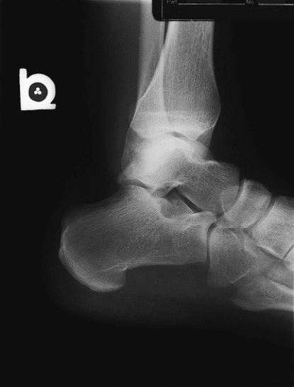 <strong>What is wrong with Figure 19-7? </strong> A) Anatomy is rotated to the left. B) A radiographic marker is not present. C) There is too much density on the image. D) The image contrast is too high.