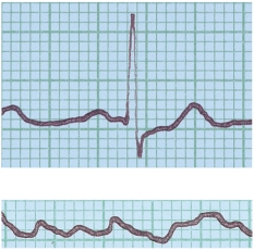 <strong>In the figure shown here,the top ECG shown is normal.What condition does the bottom ECG indicate? </strong> A) ventricular fibrillation B) a heart murmur C) hypertension D) stroke E) angina pectoris
