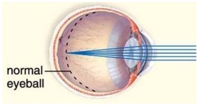 In the abnormal eyeball pictured here,the size of a normal eye is noted with a dotted line.This type of abnormality results in