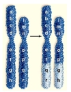 <strong>The following picture depicts which of the following changes in chromosome structure. </strong> A)deletion B)duplication C)translocation D)aneuploidy