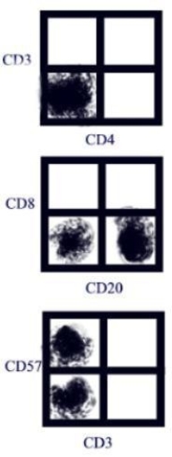 <strong> A transplant recipient showed signs of rejection, so she was treated with monoclonal anti- CD3 (OKT3). Flow cytometry was done on her blood after treatment with results as shown in the figure. The gate was set on lymphocytes. What is the best interpretation of that analysis given?</strong> A)The treatment is working adequately. B)The treatment is not working adequately. C)The fluorescent compensation was not set correctly. D)The lymphocyte gate was not set correctly.
