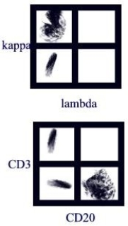 <strong> A patient presented with a very high white blood count with 90% lymphocytes. Flow cytometry analysis was done with the gate set on the lymphocytes. What is the best interpretation of the results below?</strong> A)B cell leukemia B)Granulocytic leukemia C)T cell leukemia D)Leukocytosis due to infection