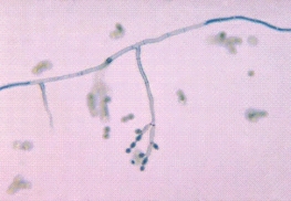 <strong>A graduate student returning from a month-long fieldwork experience in South America develops a dark nodular lesion on his left hand.Microscopic examination of the nodule reveals dark, coinlike inclusions.The following organism grows in culture.This organism is most likely: </strong> A)Cladosporium spp. B)Candida spp. C)Coccidioides immitis. D)Cryptococcus neoformans.