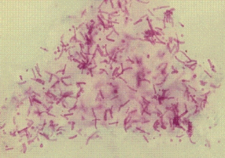 <strong>A patient returning from a trip to tropical Africa comes to his physician noting scaly patches of skin along the waistband, which are lighter in color than his normal skin.A skin scraping reveals budding yeast and short septate hyphal elements, with some branching present.This organism, shown below, is most likely: </strong> A)Malassezia furfur. B)Trichophyton schoenleinii. C)Microsporum audouinii. D)Trichophyton rubrum.