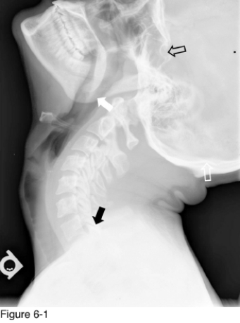 <strong> Figure 6-1 is a(n) ________ cervical spine radiograph.</strong> A) Flexion B) Extension C) Neutral lateral D) Posterior oblique