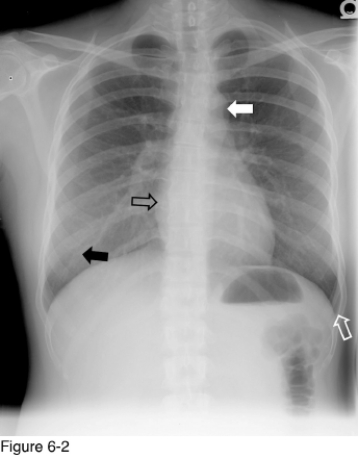 <strong> What structure is indicated by the white arrow?</strong> A) Right pulmonary artery B) Aortic arch C) Descending thoracic aorta D) Left innominate vein