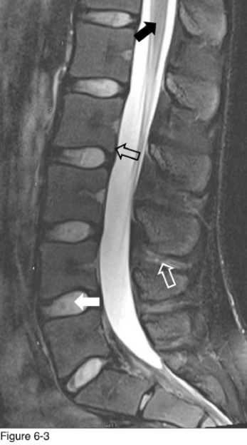 <strong> The structure indicated by the black open arrow is the __________.</strong> A) Anterior longitudinal ligament B) Posterior longitudinal ligament C) Epidural fat D) Ligamentum flavum