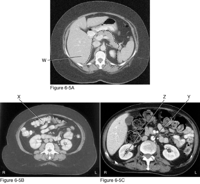 <strong> What structure is indicated by W in Figure 6-5A?</strong> A) Liver B) Spleen C) Pancreas D) Small bowel