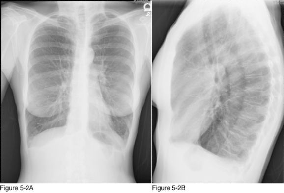 <strong> The major finding in the radiographs in Figure 5-2 is __________.</strong> A) lung hyperinflation B) accentuated pulmonary interstitial C) cardiomegaly D) decreased bone density