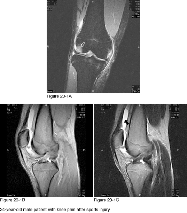 <strong> In Figure 20-1C the area of increased signal intensity marked by the black arrow is a(an) __________.</strong> A) Intra-articular effusion B) Synovitis C) Baker cyst D) Arterial aneurysm