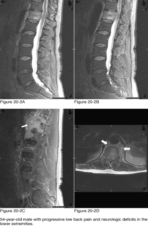 <strong> What spine region is imaged in Figure 20-2A through Figure 20-2D?</strong> A) Cervical B) Thoracic C) Lumbar D) Sacrum/coccyx