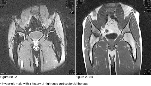 <strong> What body region is imaged in Figure 20-3A and Figure 20-3B?</strong> A) Shoulders B) Hips C) Abdomen D) Uterus