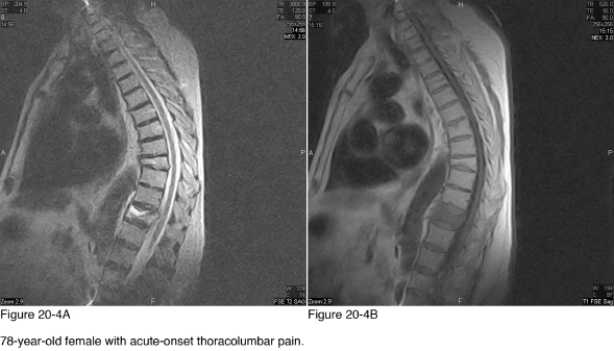 <strong> What can be inferred from comparing the signal intensity of the T8 and T11 vertebral bodies?</strong> A) The T8 lesion is acute B) The T11 lesion is acute C) Both lesions are acute D) Both lesions are chronic