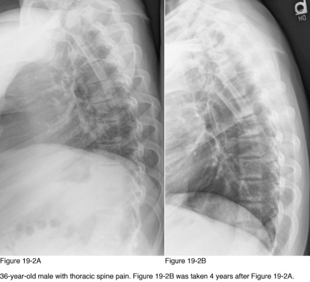 <strong> Which radiographic pattern of disease is observed in Figure 19-2?</strong> A) Generalized osteosclerosis B) Arthritides C) Soft tissue calcification D) Soft tissue ossification