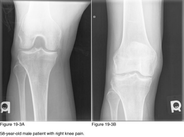 <strong> The underlying etiology of the disease observed in Figure 19-3A and Figure 19-3B is__________.</strong> A) Autoimmune disease B) Infection C) Degenerative osteoarthritis D) Endocrine/metabolic disease
