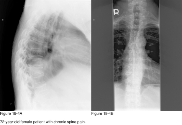 <strong> Which of the following diagnostic studies provide greatest sensitivity in assessing bone mineral density?</strong> A) Bone scan B) Digital radiography C) SPECT D) DEXA