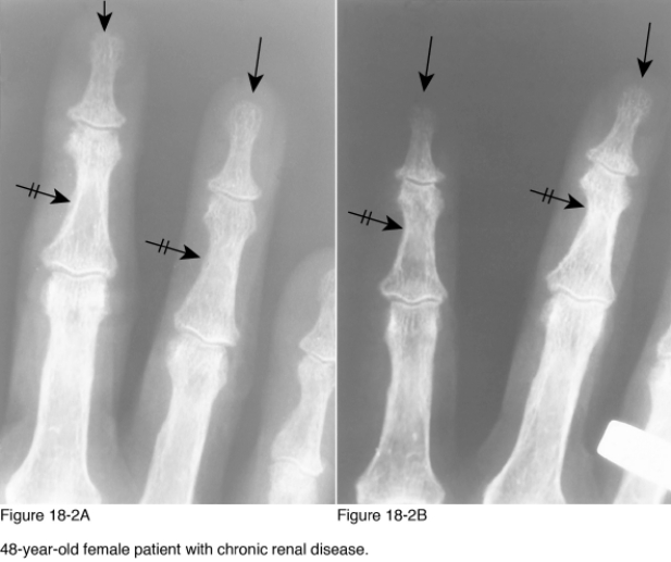 <strong> Which of the following radiographic diagnoses best accounts for the changes observed on the area marked by the crossed arrows in Figure 18-2?</strong> A) Neurotrophic disease B) Psoriatic arthritis C) Scleroderma D) Hyperparathyroidism