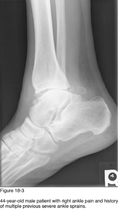 <strong> Which of the following radiographic findings supports your answer to the most likely cause of the abnormalities observed in Figure 18-3?</strong> A) Nonuniform reduction of joint spacing B) Polyarticular involvement C) Soft tissue swelling D) Joint disintegration