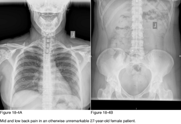 <strong> What further action/diagnostic testing is necessary to manage this patient specific to the radiographic abnormalities noted in Figure 18-4?</strong> A) No further action B) Radiographic survey of the major joints C) Referral to an oncologist D) Referral to a rheumatologist