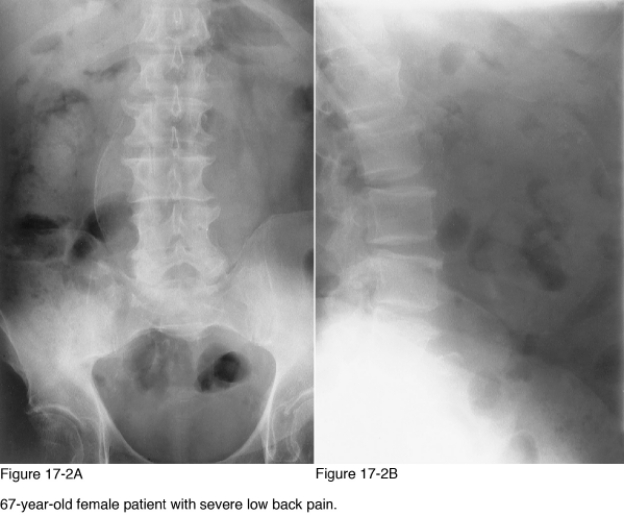 <strong> Which infection is most likely to result in paraspinal calcification secondary to abscess formation?</strong> A) Salmonella B) Staphylococcus aureus C) Echinococcus granulosus D) Mycobacterium tuberculosis