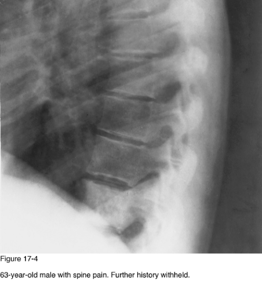 <strong> If Paget disease was the underlying cause for the abnormality present in Figure 17-4, which radiographic finding would likely also be observed?</strong> A) Vertebra plana B) Narrowed intervertebral disc C) Vertebral enlargement D) Paraspinal ligament ossification