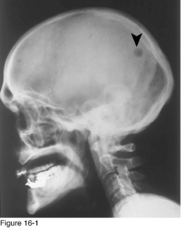 <strong> Which of the following radiographic patterns of disease is represented in Figure 16-1?</strong> A) Basilar invagination B) Intracranial calcifications C) Radiodense mandible lesions D) Osteolytic defect of the skull