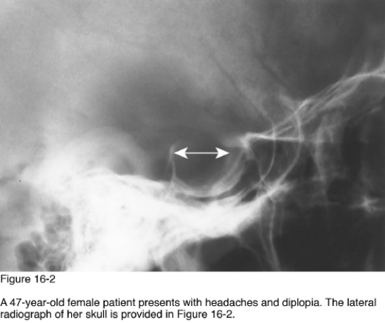 <strong> Enlargement of the sella turcica secondary to entrasellar extension of the subarachnoid space through defect in the diaphragm sellae describes __________.</strong> A) Increased intracranial pressure B) Aneurysm of the carotid vessel C) Meningioma D) Empty sella syndrome