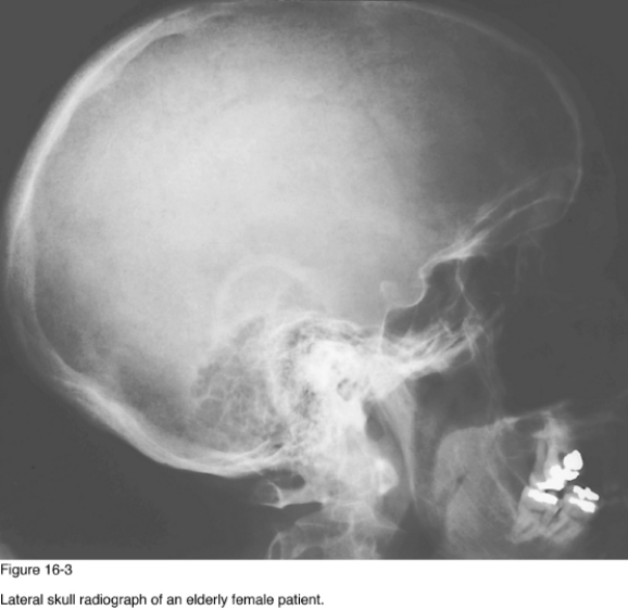 <strong> Chronic disease of the __________ may produce the appearance of the skull in Figure 16-3.</strong> A) Lungs B) Prostate C) Kidneys D) Adrenals