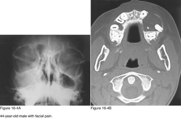 <strong> In Figure 16-4A there is opacification of the __________ sinus.</strong> A) Frontal B) Ethmoid C) Sphenoid D) Maxillary
