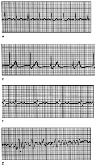 Figure 17.3 Using Figure 17.3, match the following: Ventricular fibrillation.