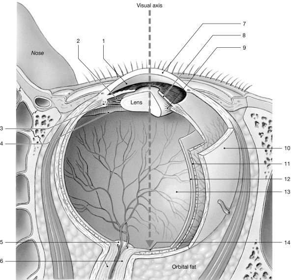 <strong>C:\User Figure 15- 1 The Sectional Anatomy of the Eye Use Figure 15- 1 to answer the following questions: Which of the following descriptions applies/apply to the term myopia?</strong> A) corrected with diverging lens B) nearsightedness C) image focused in front of retina D) A and C only E) A, B, and C