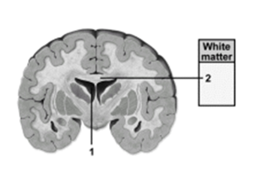 -This figure shows a frontal section of the cerebrum.What structure does number 1 indicate?