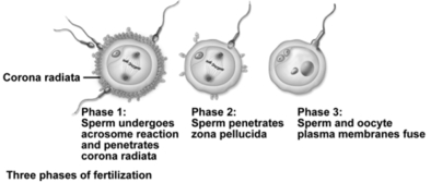 <strong>This figure shows the three phases of fertilization.Which statement is not correct concerning fertilization? </strong> A)Digestive enzymes released from the acrosome eat away the intercellular connections in the corona radiata. B)Once a sperm has penetrated the oocyte,the zona pellucida hardens to prevent additional sperm from penetrating. C)Only the sperm nucleus enters the oocyte cytoplasm. D)Fusion of pronuclei produces a diploid nucleus. E)All of the choices are correct.