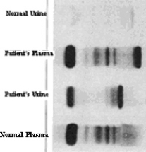 <strong>The following plasma and urine electrophoresis results were obtained from a 70-year-old man who complained to his doctor of back pain that he had had for several months and of feeling generally unwell. This patient most likely has:</strong> A)Bence Jones protein. B)Hypergammaglobulinemia. C)Waldenström macroglobulinemia. D)Agammaglobulinemia. E)High levels of immunoglobulin M (IgM).