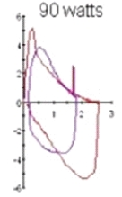 <strong>The following image shows the subject's tidal volume plotted against the maximal flow-volume loop during exercise: Which of the following clinical conditions is most consistent with these findings?</strong> A) Variable intrathoracic obstruction B) Chronic obstructive pulmonary disease C) Pulmonary fibrosis D) Variable extrathoracic obstruction
