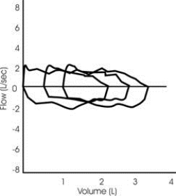 <strong>Which answer is consistent with the following three superimposed flow-volume loops? </strong> A) Normal airway function B) Small airway obstruction C) Variable intrathoracic restriction D) Fixed extrathoracic obstruction